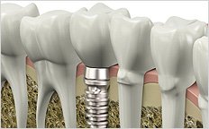 Dental implants in costa rica