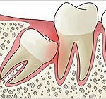 Impacted Teeth